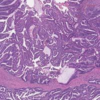 Gastrointestinal, Liver, and Pancreas Pathology Sample 1