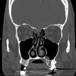 Computed tomography (CT) of the sinuses showing a spontaneous CSF leak from a right ethmoid sinus skull base defect