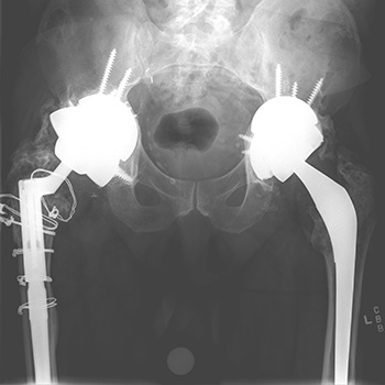 X-ray of Michael Mahoney's hip replacement done in 2016 by Wayne Moschetti, MD, MS.