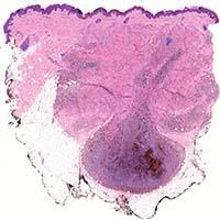 Dermatopathology Sample 3