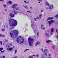 Medical Renal Pathology Sample 3