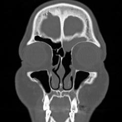CT showing a recurrent left frontal sinus inverted papilloma