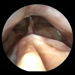 Postoperative appearance after removal of nasal polyps 