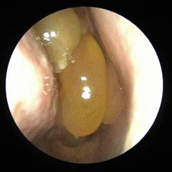 Nasal cavity polyps obstructing the sinuses