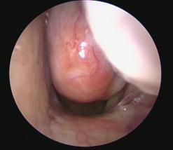 Juvenile nasopharyngeal angiofibroma on the left nasal cavity