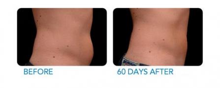 CoolSculpting before and after - example 1