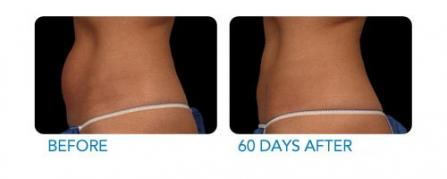 CoolSculpting before and after - example 2