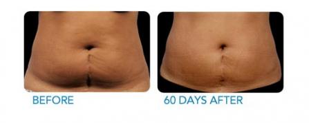 CoolSculpting before and after - example 3