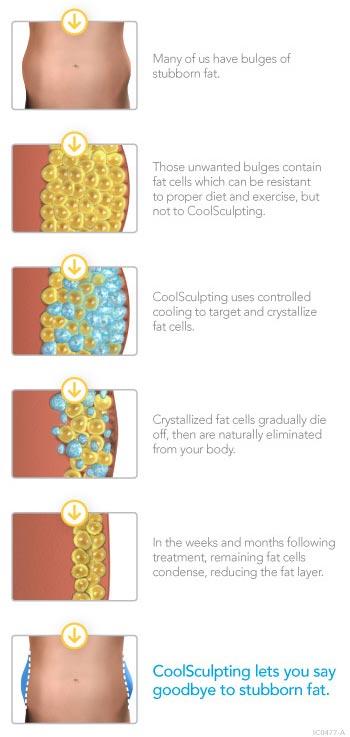 CoolSculpting Fat Reduction – Cascade Eye & Skin Centers