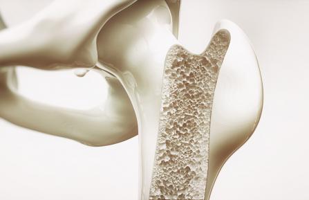 Osteoporosis in bone