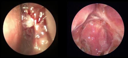 Left olfactory neuroblastoma before and after endoscopic resection