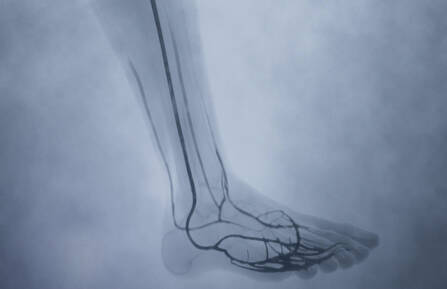 Angiogram image of leg of patient who had LimFlow procedure