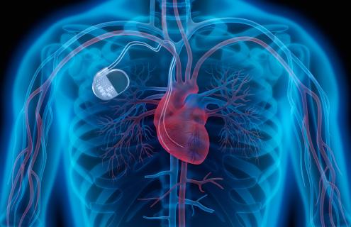 pacemaker image