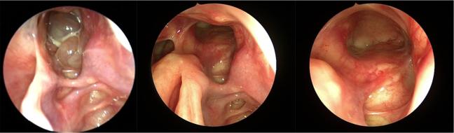 Recurrent left frontal sinus inverted papilloma before and after resection