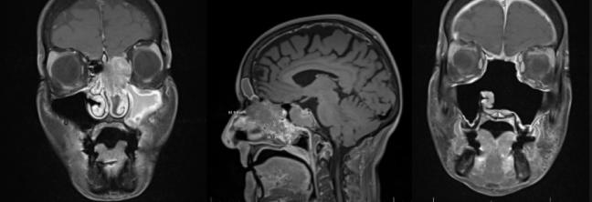 MRI of a left olfactory neuroblastoma before and after resection